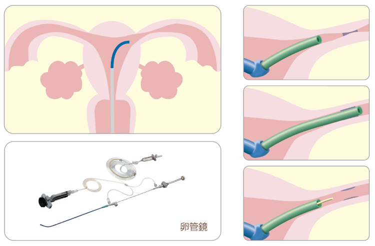 卵管鏡下卵管形成術（FT）
